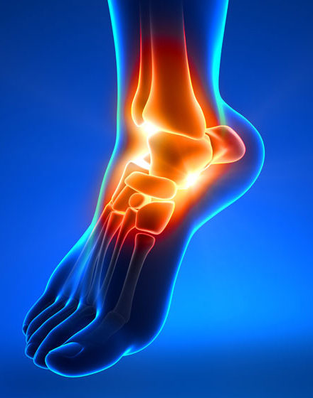 Ankle Arthritis